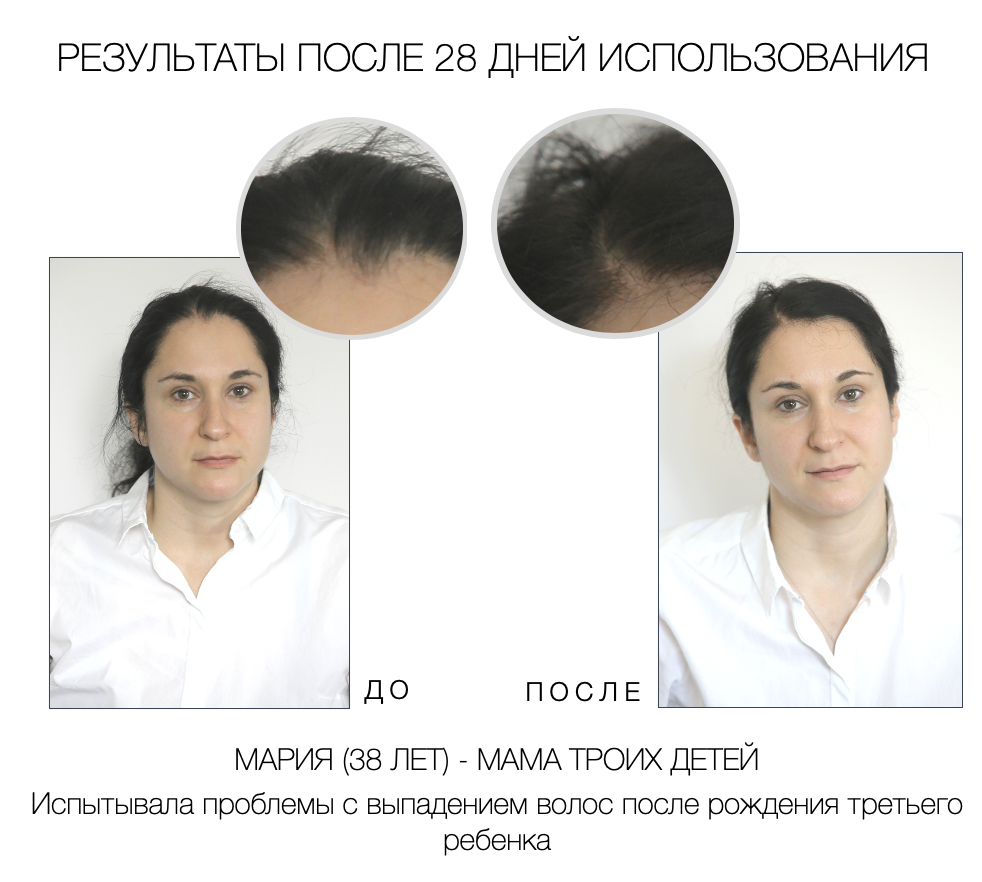ИНТЕНСИВНАЯ ПРОГРАММА ПРОТИВ ВЫПАДЕНИЯ И ИСТОНЧЕНИЯ ВОЛОС